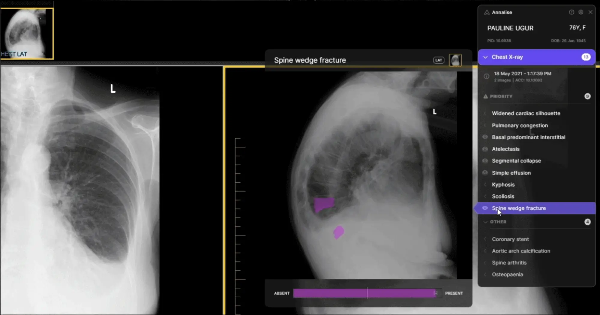 Annalise AI chest X-ray viewer highlighting a spine wedge fracture in a findings list